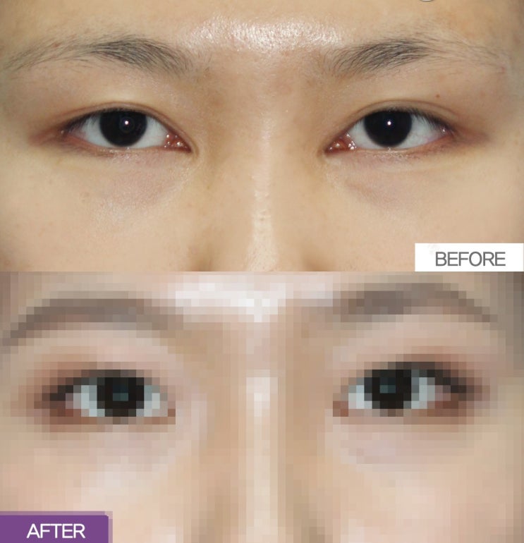 Can epicanthoplasty scars be improved with careful treatment?