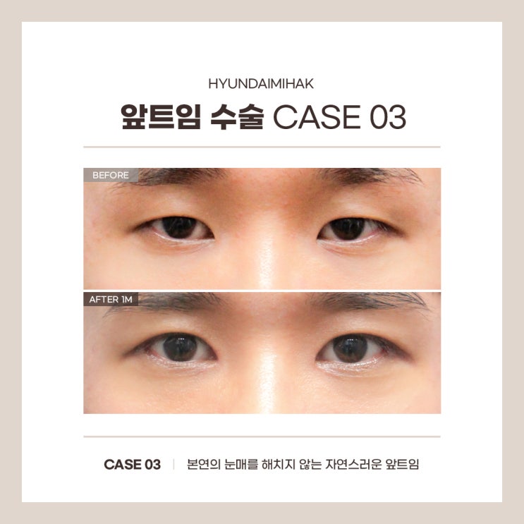 Gangnam epicanthoplasty: improving epicanthal folds, overcoming side effects, and maximizing surgical results