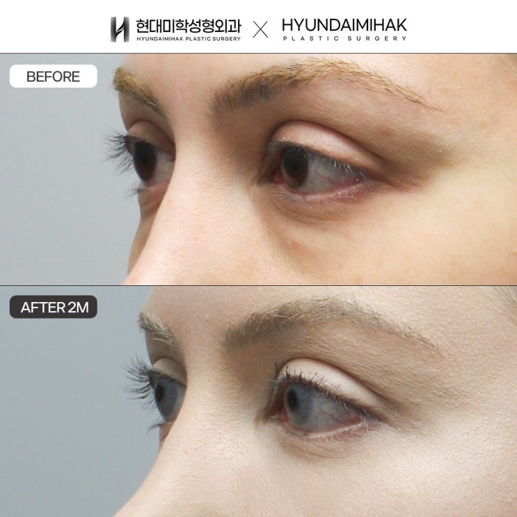 Under-eye fat repositioning surgery review: an impression that makes you look older