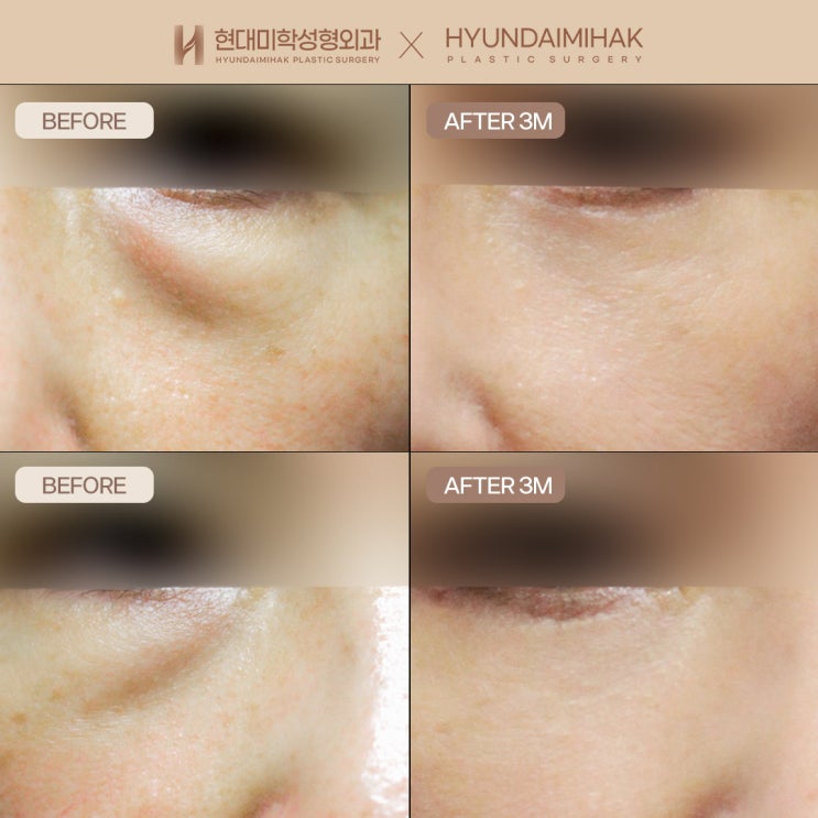 Middle-Aged Lower Blepharoplasty: Maintain a Beautiful Appearance That Defies Time