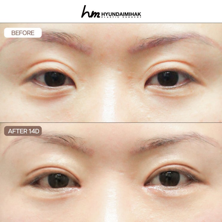 Why Hyundai Aesthetic Surgery Is Gaining Attention for Double-Eyelid Line Lowering Surgery