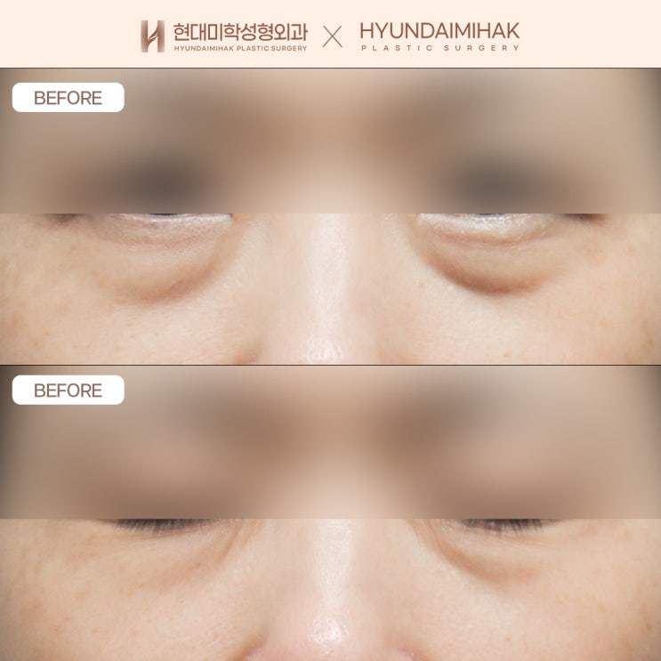 A clinic skilled in lower blepharoplasty for sagging, drooping under-eyes