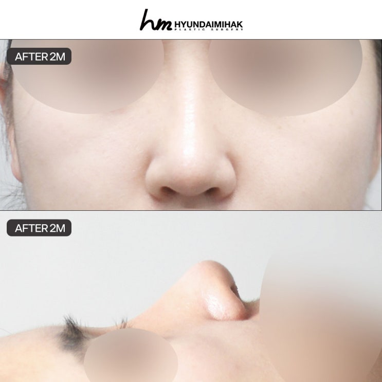 Natural-Defined Rhinoplasty: A Solution Between Natural Softness and Clear Definition