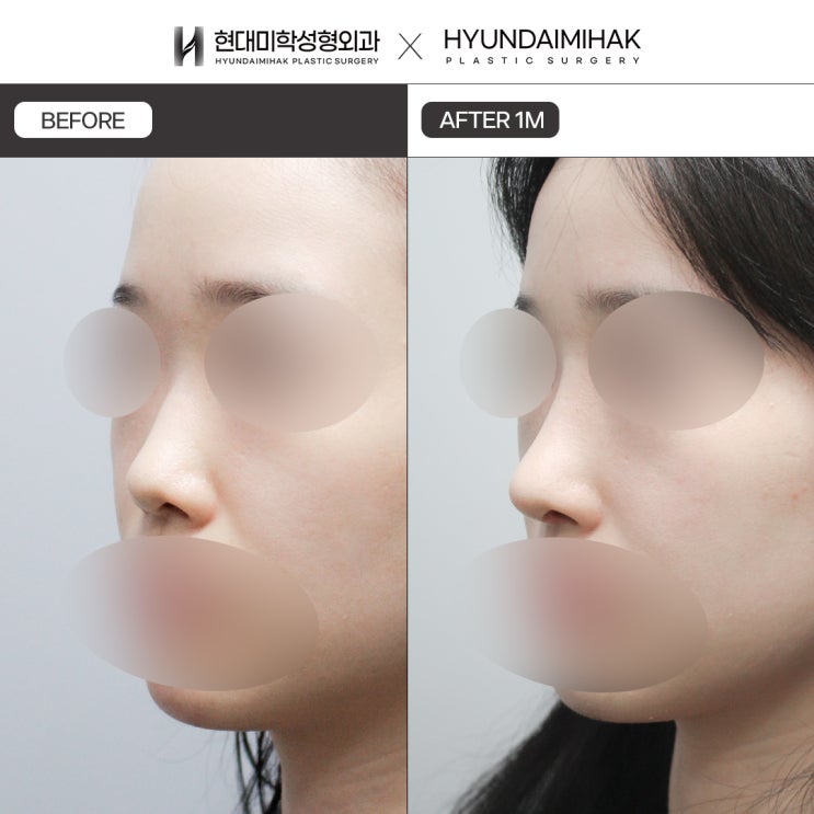 Low Nose Surgery: Creating Harmony Between the Bridge and Tip