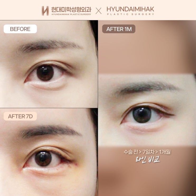 Improving the eye shape naturally and softly with surgery to lower the outer corners of the eyes