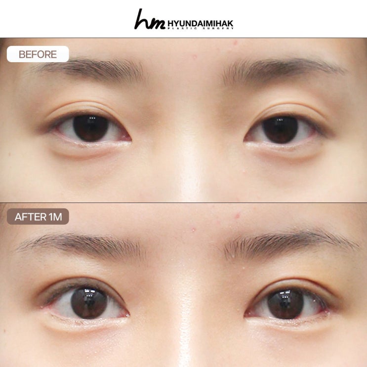 Checklist for Visiting a Plastic Surgery Consultation: Eyes, Nose, Thread Lifting, and Liposuction