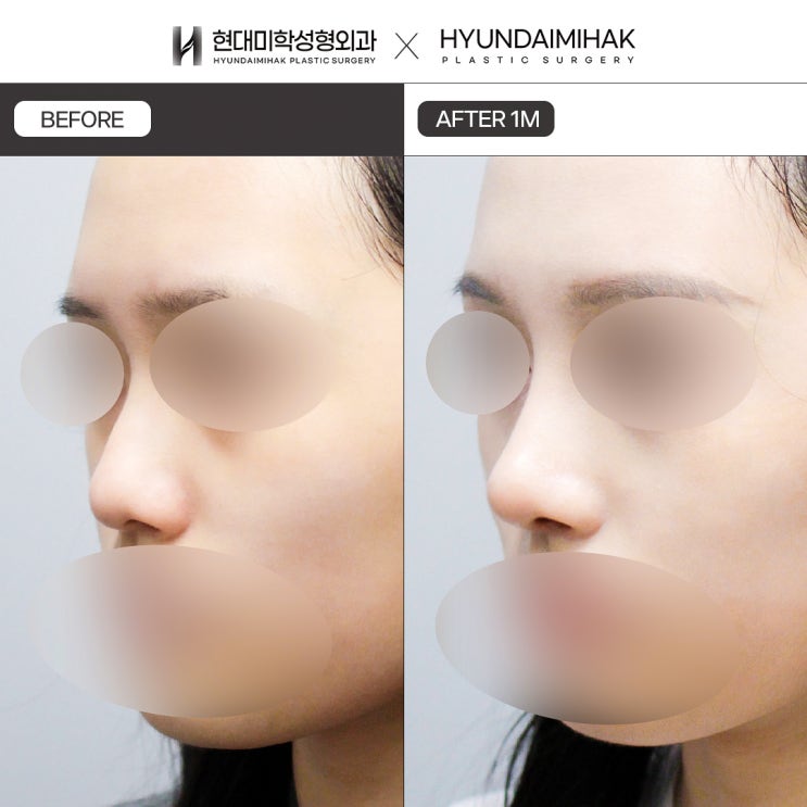 Before and After Closed Rhinoplasty: Invisible Scars