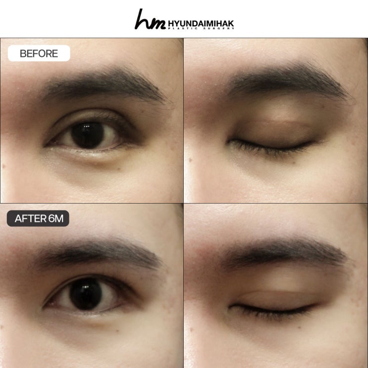 Choose a clinic for complex eye revision surgery with no room for failure