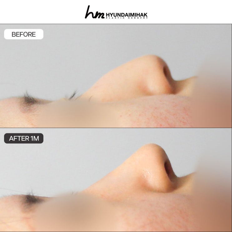 Best Hospital for Hump Nose Surgery: Now Is the Time to Make a Change