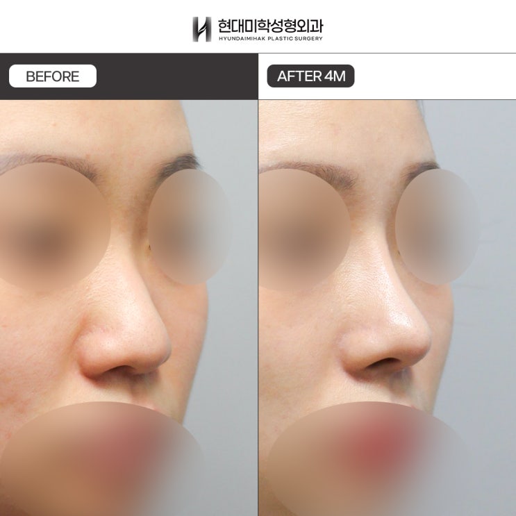 Straight-to-soft-curve rhinoplasty: low nose correction for a natural, refined change
