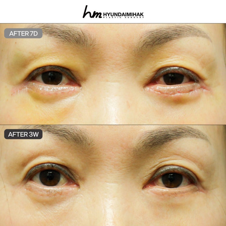 If You Want Natural Results Without Scars from Lower Eyelid Surgery