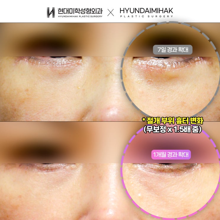 A Secret to Rejuvenation from a Clinic Known for Lower Blepharoplasty