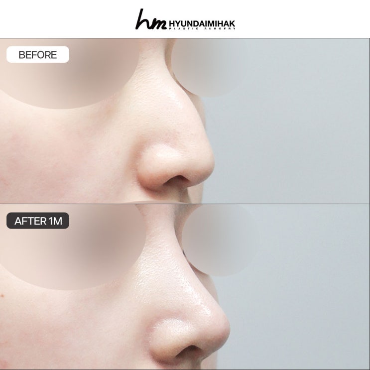 Hump Nose Surgery Reviews: Successful Cases at Hyundai Aesthetic Surgery