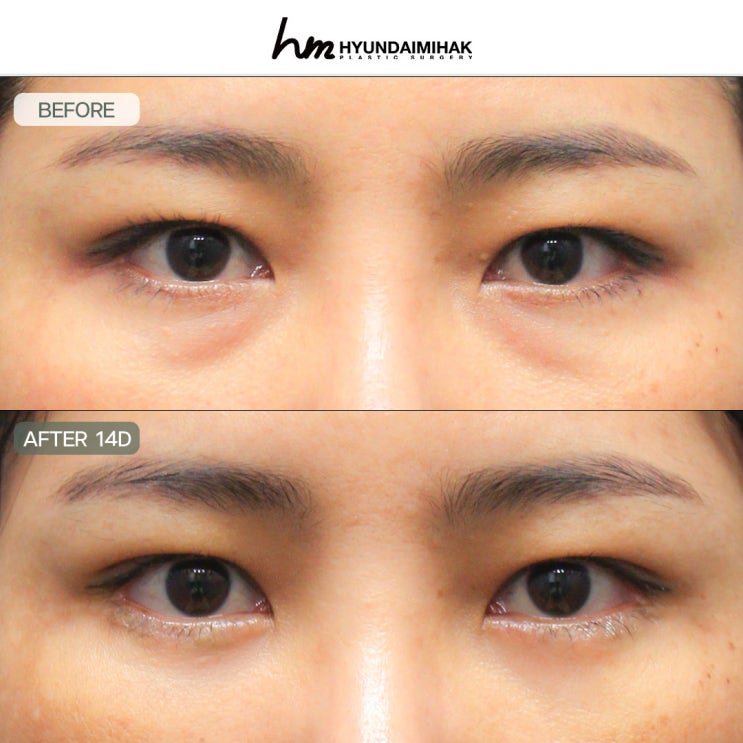 Must-read before consulting an under-eye bag clinic: look younger without side effects