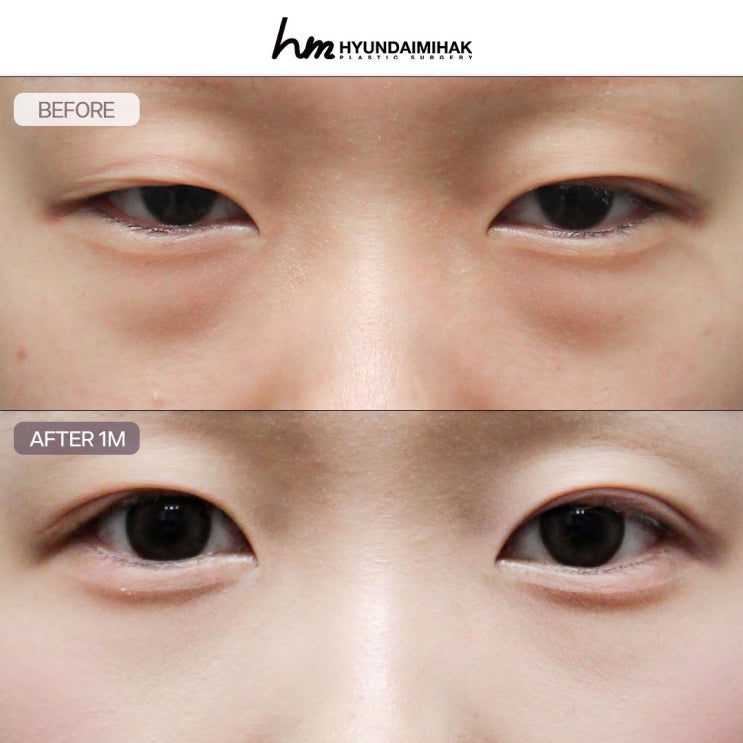 Before and After Under-Eye Fat Repositioning: A Younger Face and Faster Recovery