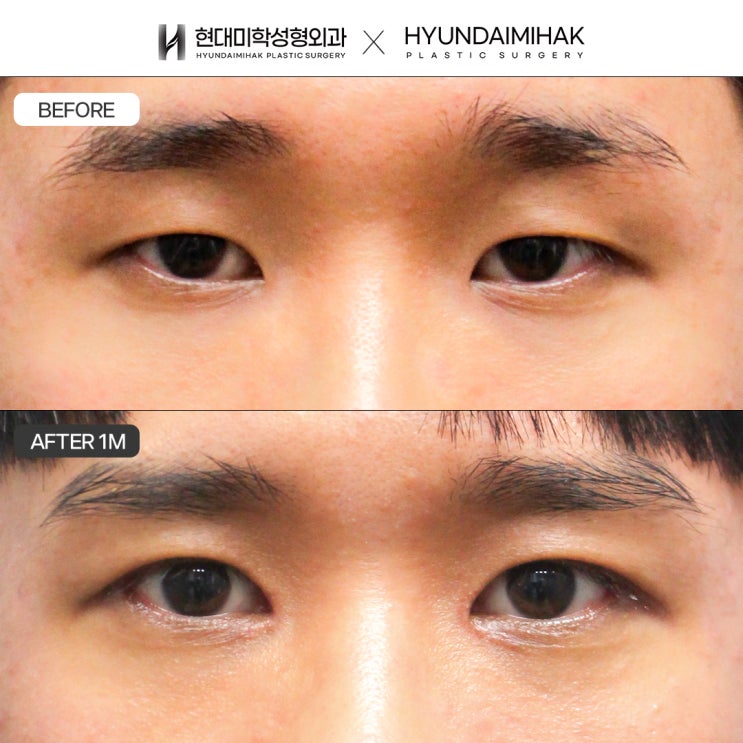 A trusted clinic for ptosis correction, for a clearer, more defined impression