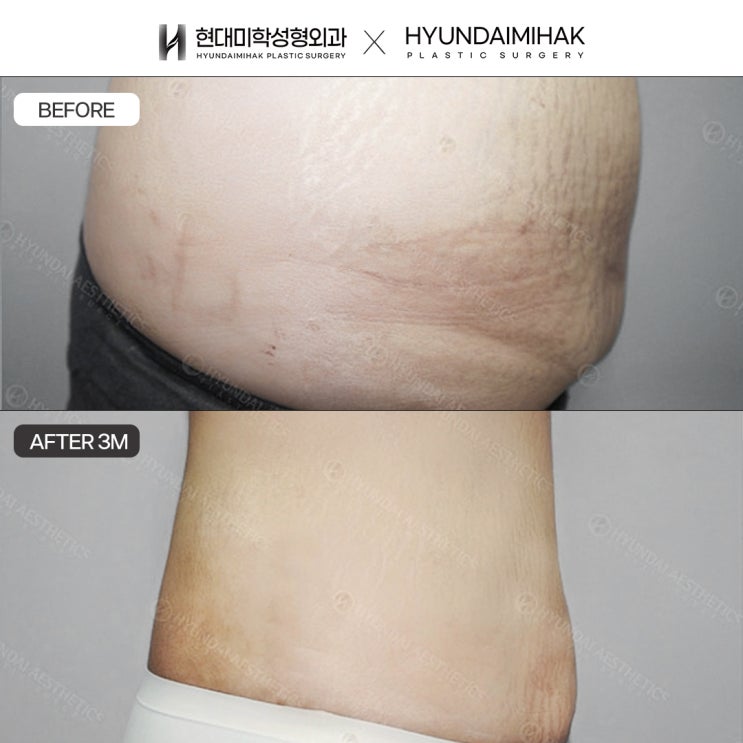 What You Need to Know About Large-Volume Liposuction