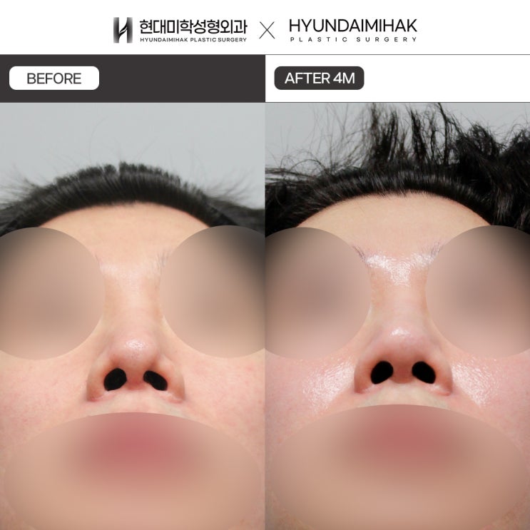 Causes, solutions, and prevention methods for revision surgery for a pinched nose