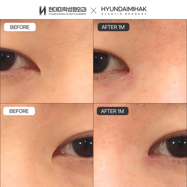 How to Improve Complexes with Epicanthoplasty Scar Removal and Its Effects