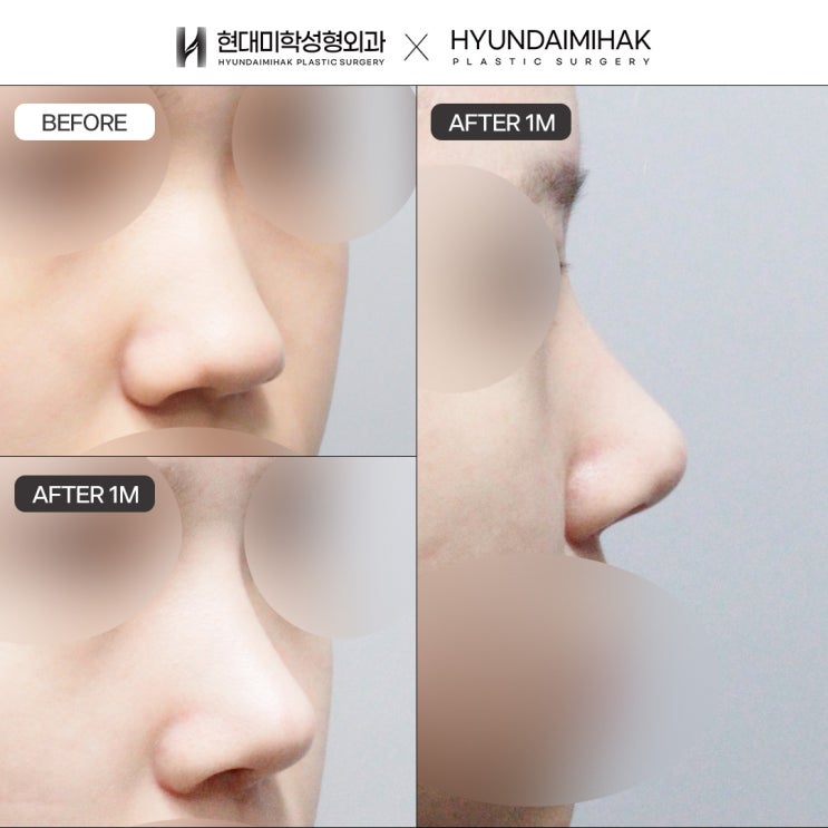 Autologous Rib Cartilage Rhinoplasty: A New Choice for Natural Nose Line Improvement