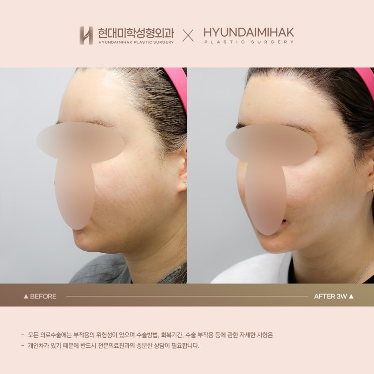 Before and After Double Chin Liposuction: Facial Line Refinement Effect