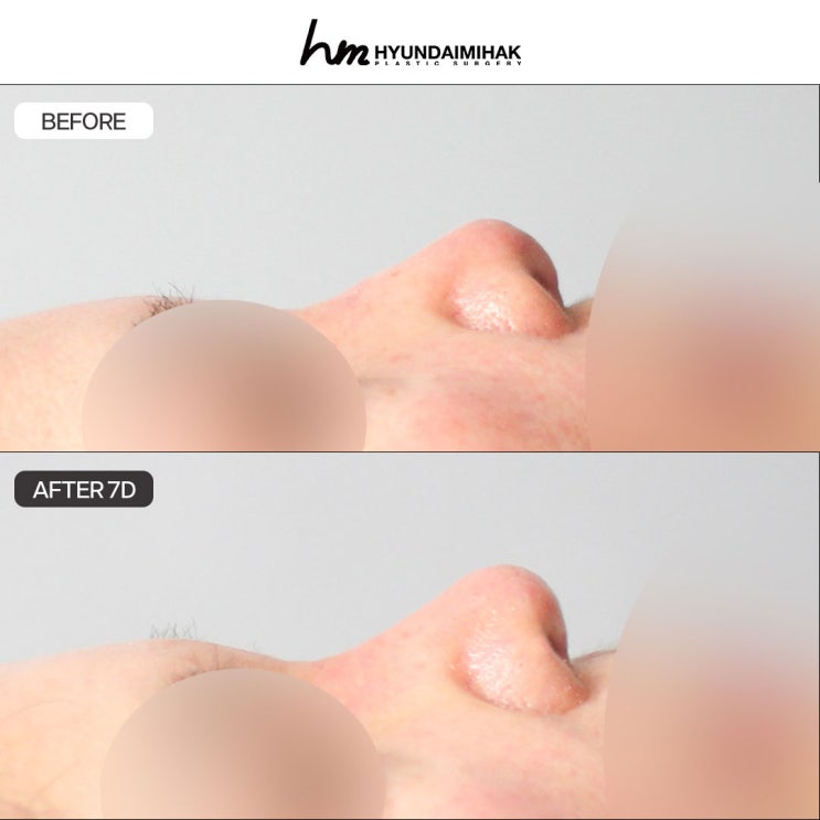 Nasal reconstruction surgery: Hyundai Aesthetic Surgery is different