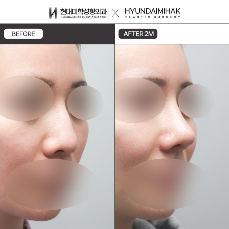 Comparison of Low Nose Surgery Prices