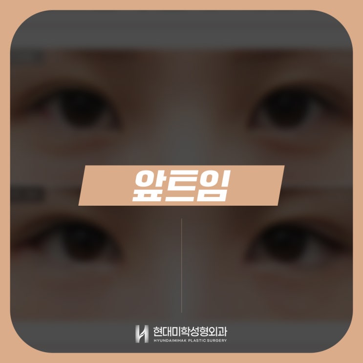 Epicanthoplasty: The Secret to Naturally Defined Eyes
