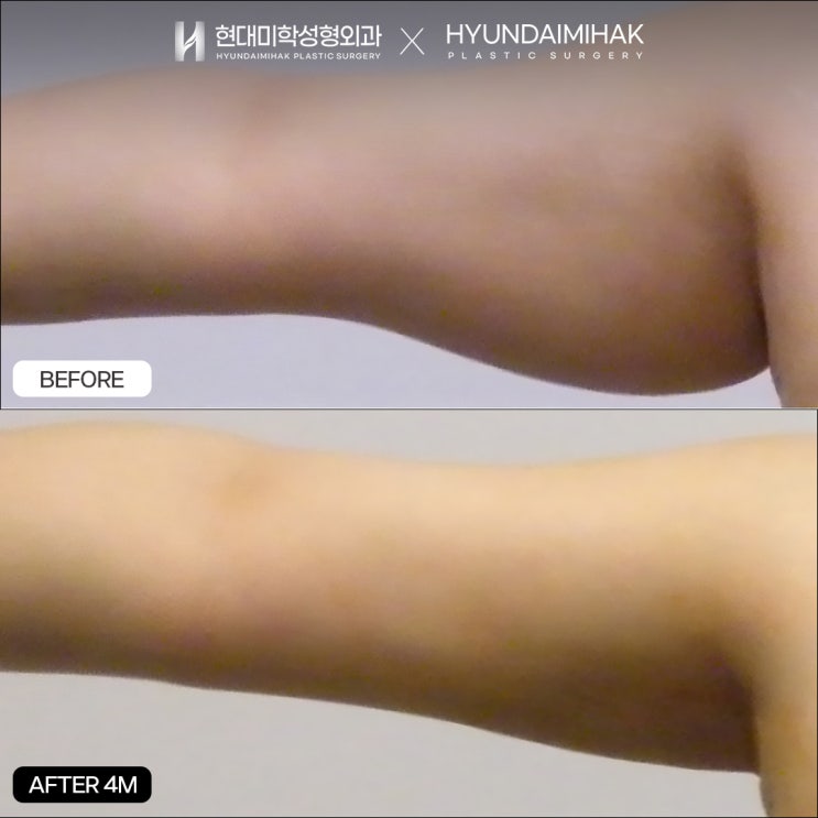How to achieve effective results at a reasonable liposuction price