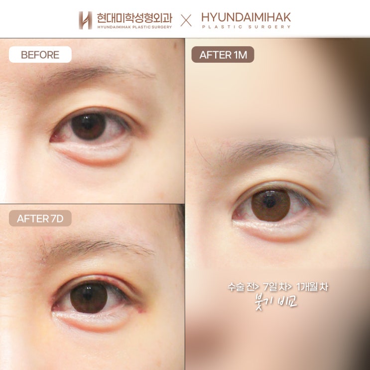 What determines the cost of eyelid revision surgery?
