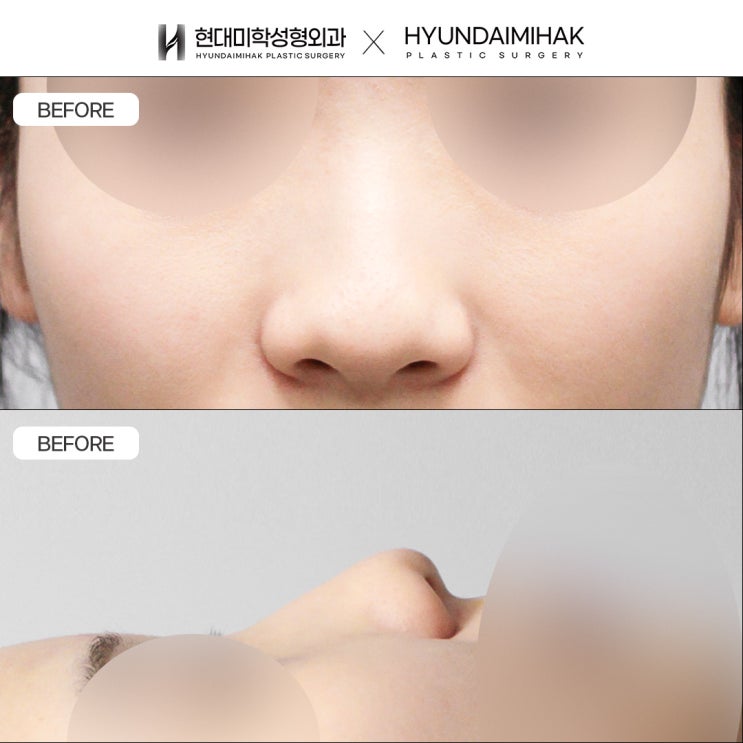 Non-Implant Tip Plasty for a Slimmer, More Refined Nose