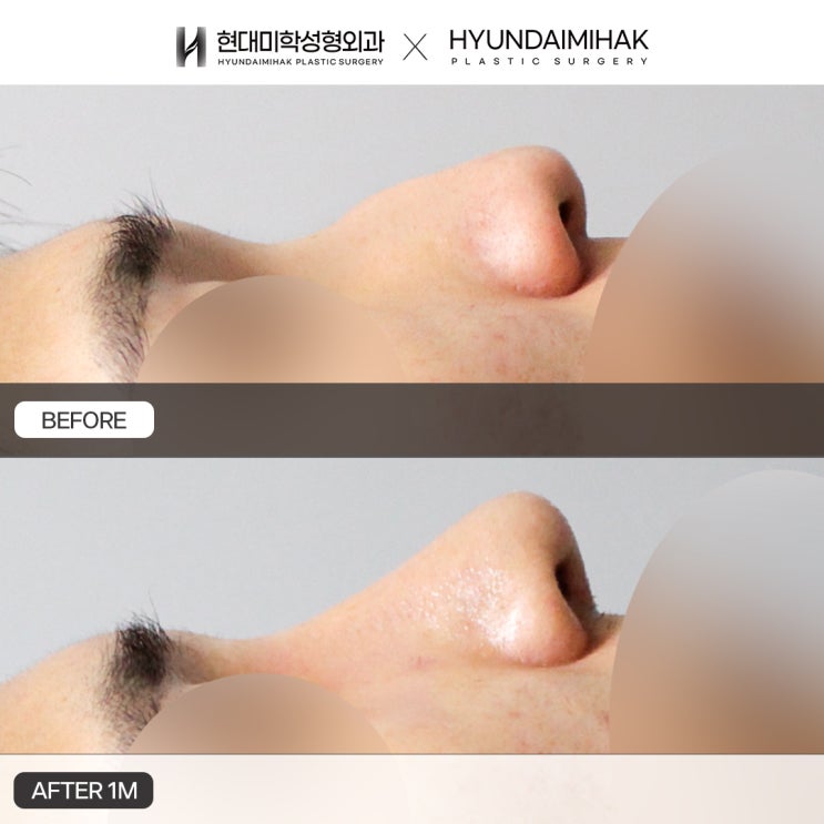 Male Hump Nose Correction: Improving a Prominent Nasal Hump