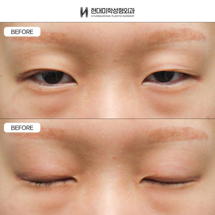 A Clinic Skilled in Ptosis Correction: Improving Droopy Eyes