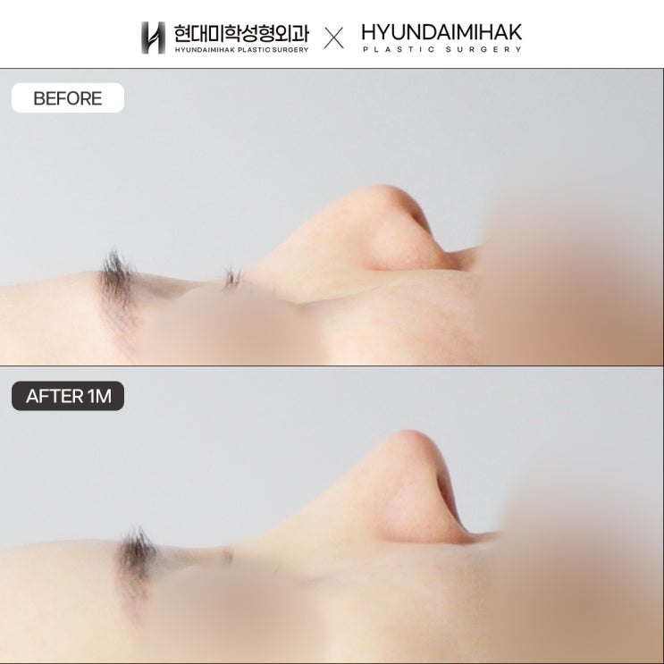Revision rhinoplasty with rib cartilage using firm, durable material