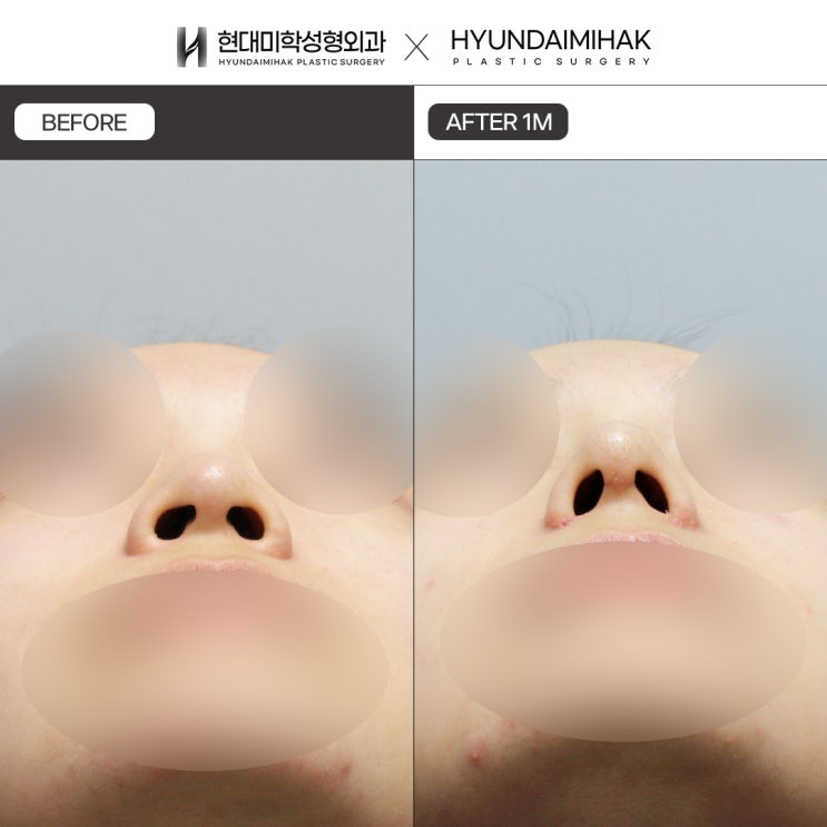 Before and After Alar Reduction: If You Are Concerned About a Rounded Nose