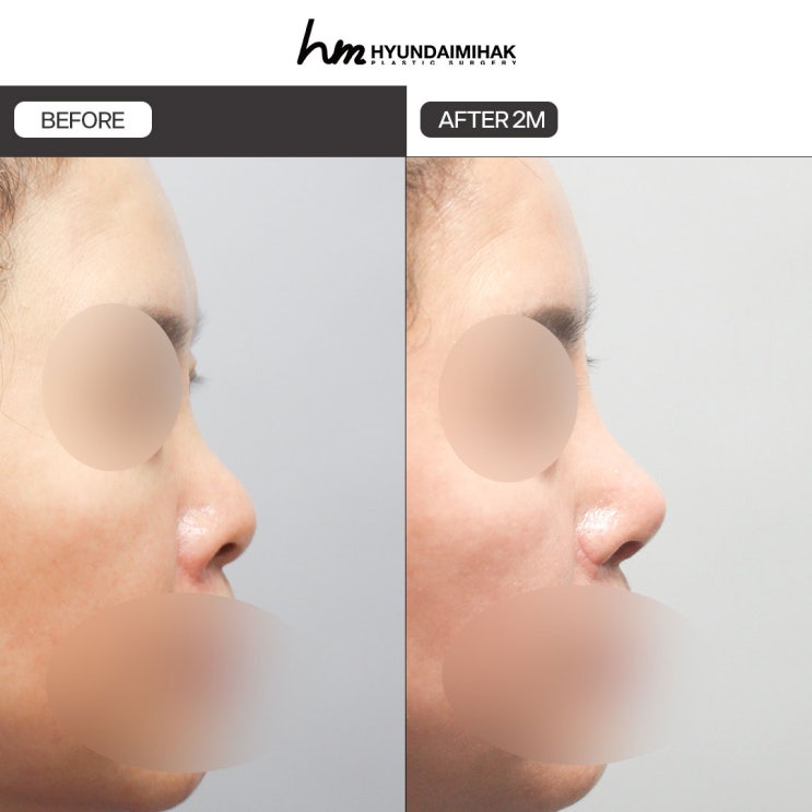 Changing Your Impression with the Subtle Difference of Alar Reduction