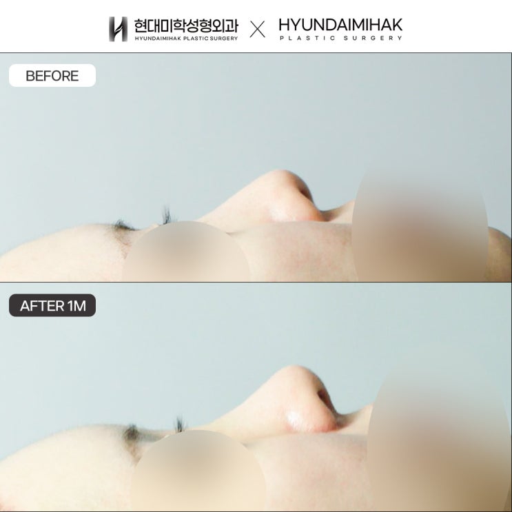 Achieving a Straight Nose for Women That Harmonizes with the Face