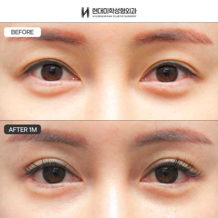 Dual Canthoplasty Reviews: How to Escape a Stuffy-Looking Eye Shape