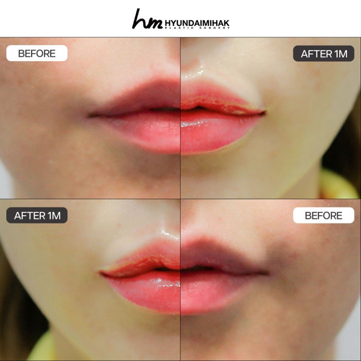 Lip Surgery Review: Transforming a Stern-Looking Face into a More Approachable Impression