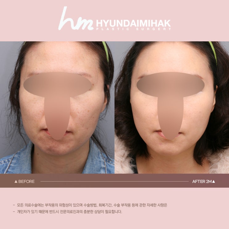 Middle-Aged Lifting: Maintaining a Youthful Look Even After Your 50s