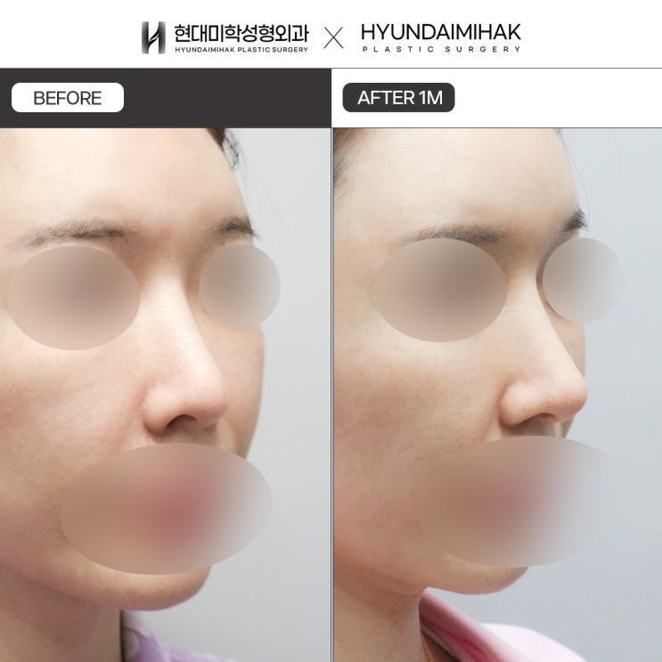 Autologous Rib Cartilage Rhinoplasty: Safely Achieving a Natural-Looking Nose