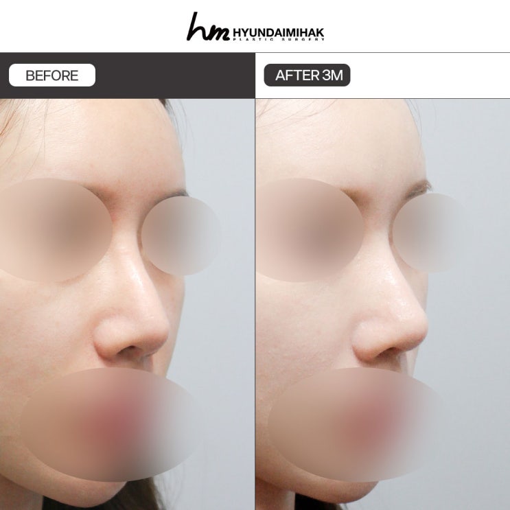 A Smart Way to Choose Rhinoplasty for the Nasal Bridge by Considering Cost and Aftereffects