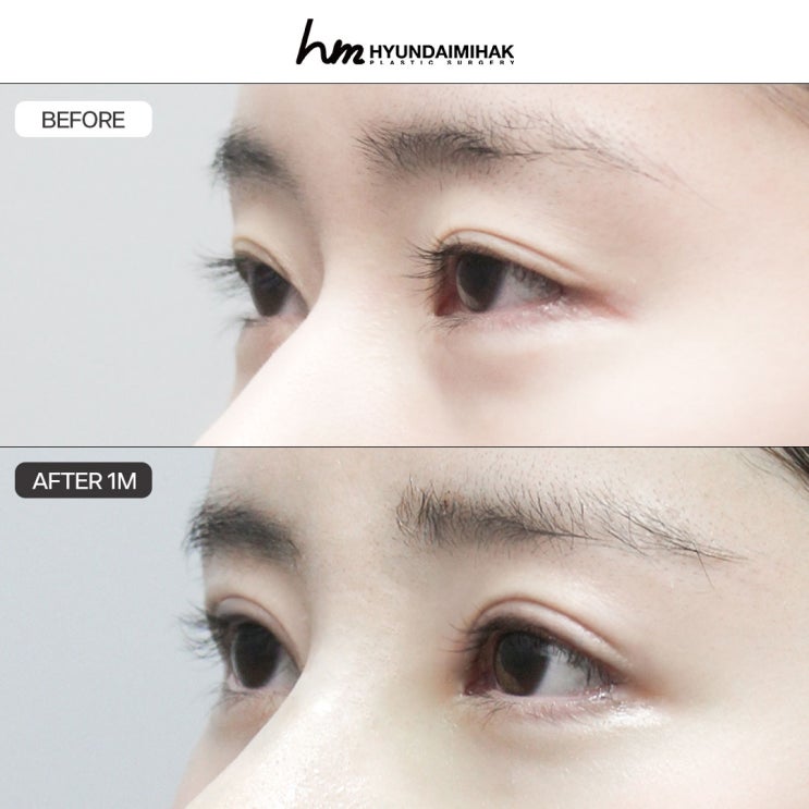 A Complete Guide to the Before-and-After Effects and Recovery Process of Lateral Canthoplasty
