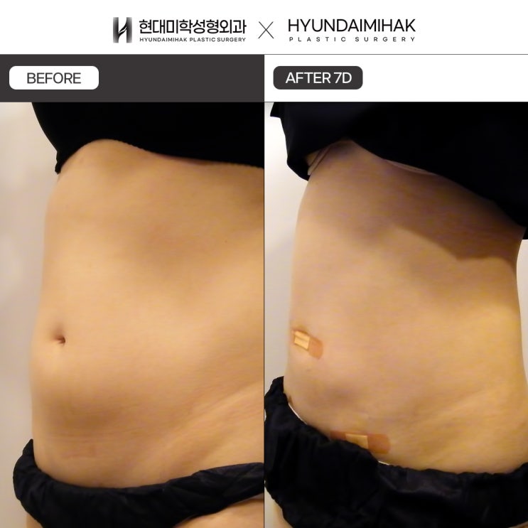 Mini Liposuction Cost: A Smart Choice for a Balanced Body Line