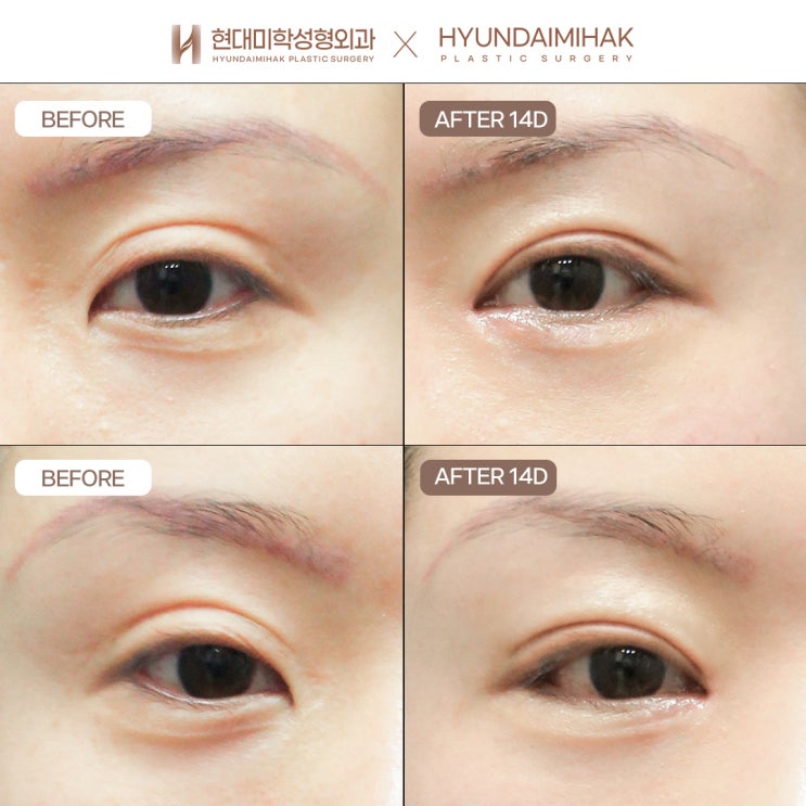 If your lowered double-eyelid line looks thick, like a sausage fold