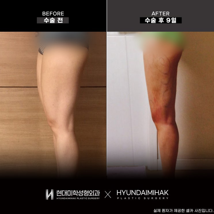 Choosing a liposuction plastic surgery clinic can change your body