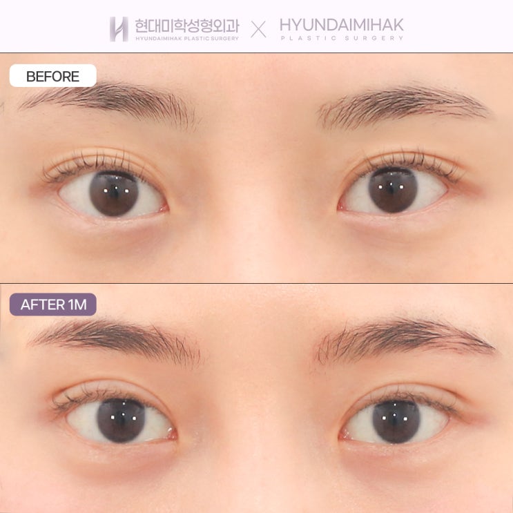 How to Achieve the Best Results at a Reasonable Price for Asymmetrical Eye Correction