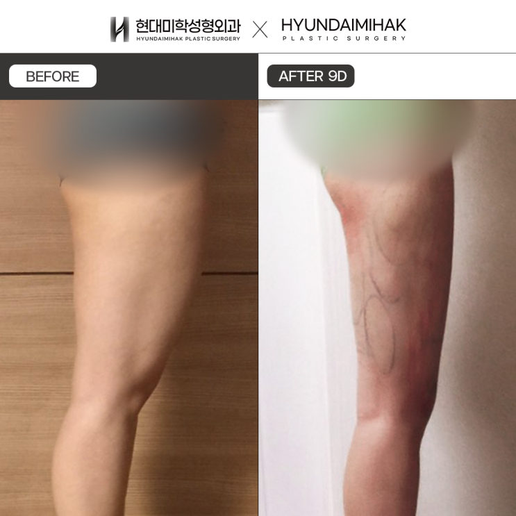 Petite Liposuction: A Simple Way to Complete Your Body Line and End Your Concerns in Just One Day