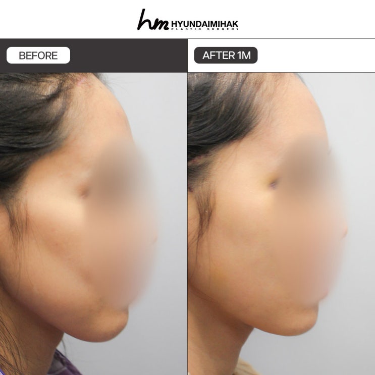 Facial Fat-Dissolving Injections: Complete a Naturally Firm and Slim Line