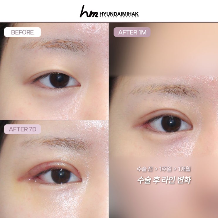 Dual Epicanthoplasty and Canthoplasty Reviews: How to Clearly Transform Small, Constricted-Looking Eyes